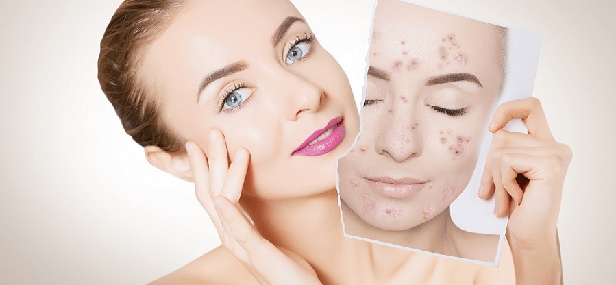 acne-min