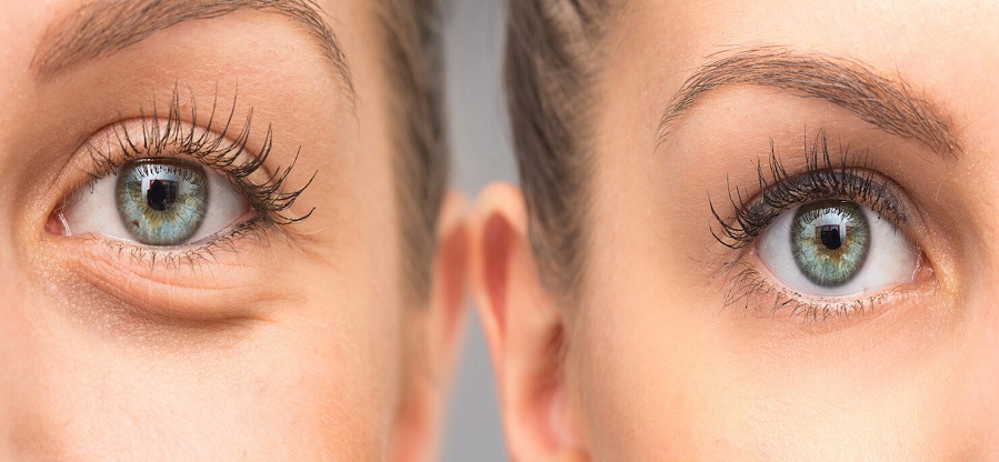 before-after-eye-cirlces-treat-makeup-1480x550-1 (1)