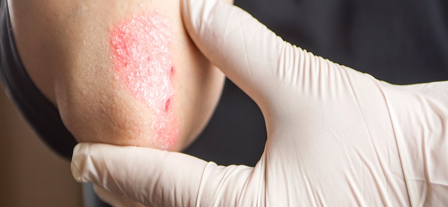 Psoriasis-and-other-skin-rashes-treated-in-Exeter-Torquay-Devon-Bristol-London-by-skin-experts