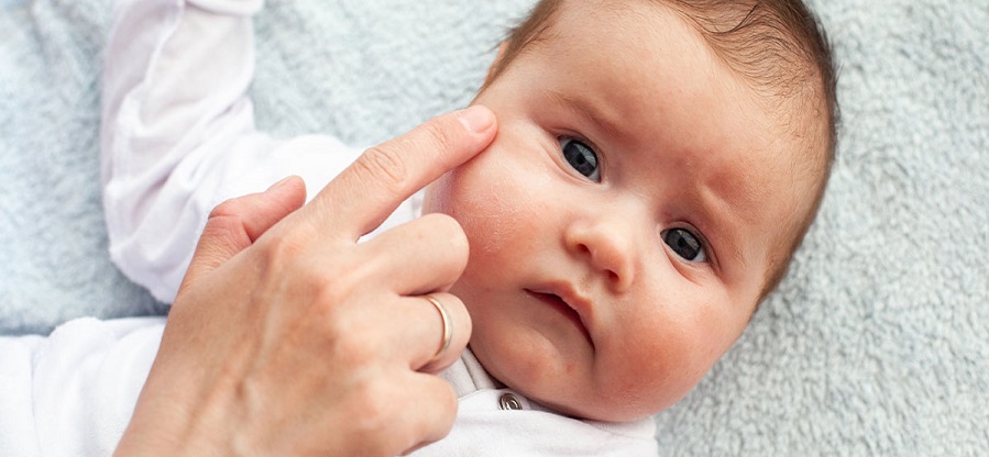 baby--eczema-banner-1200x500