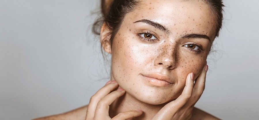hyperpigmentation