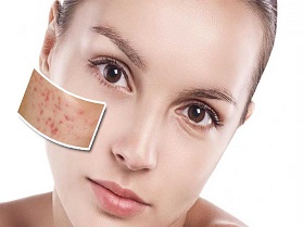 انواع لیزر جای جوش