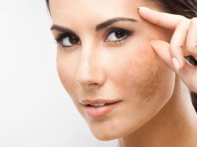 روش های پیشگیری از لک پوستی