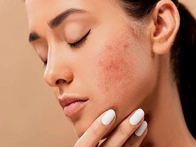 روش های طبیعی پیشگیری از لک
